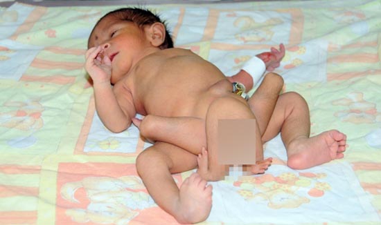 تولد کودکی با 6 پا در پاکستان