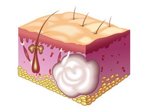 شناخت بیماری کیست (cysts) و راهای درمان 1