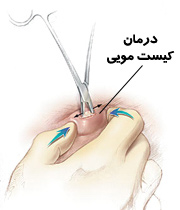 شناخت بیماری کیست (cysts) و راهای درمان 1