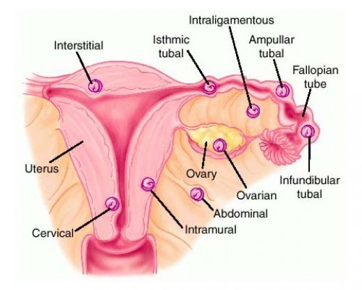 حاملگی خارج از رحم چیست؟! +عکس حاملگی خارج از رحم چیست؟! +عکس