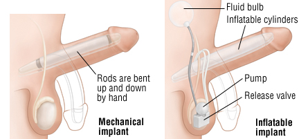 Symptoms of having low testosterone