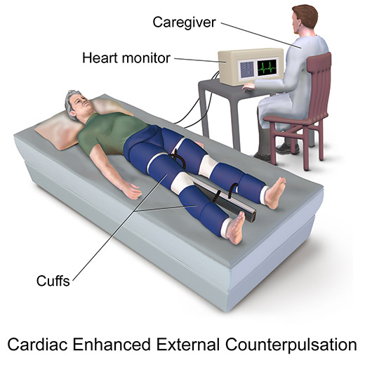 Cardiac Enhanced External Counterpulsation
