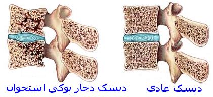 پزشکی: سن پوکی استخوان در بین ایرانی ها پزشکی: سن پوکی استخوان در بین ایرانی ها