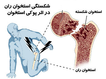 پزشکی: سن پوکی استخوان در بین ایرانی ها پزشکی: سن پوکی استخوان در بین ایرانی ها