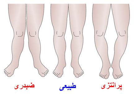 زانوی کج ، علتها و درمان
