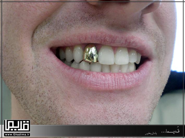روکش طلای دندان