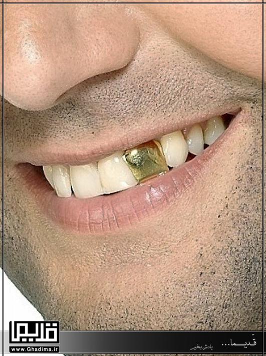 دندان طلایی