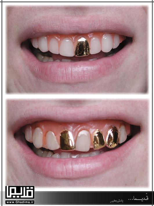 دندان طلا