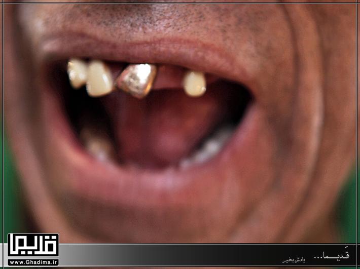 دندان طلا
