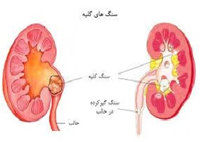 پزشکی: 10 فرمان ضد سنگ کلیه پزشکی: 10 فرمان ضد سنگ کلیه