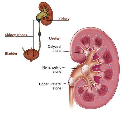image of kidney stone passing